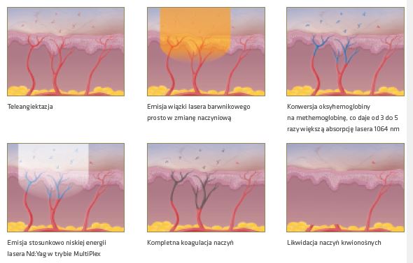 Lasery dermatologiczne CYNOSURE Cynergy