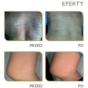 Lasery dermatologiczne DEKA Motus AY