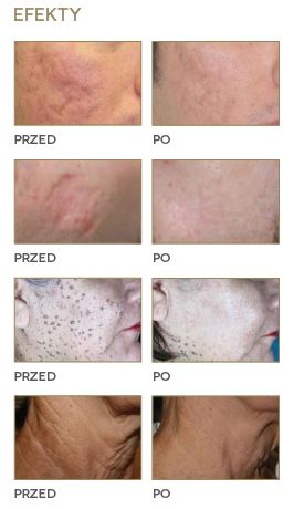 Lasery dermatologiczne DEKA SMARTXIDE2 DOT/RF Golden Touch