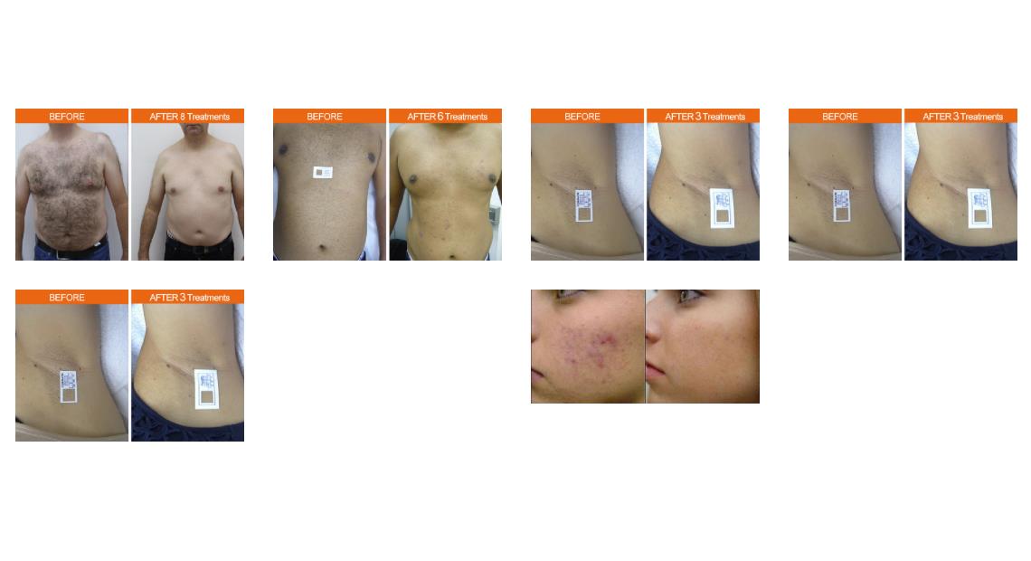 Lasery dermatologiczne FormaTK MAGMA Spark