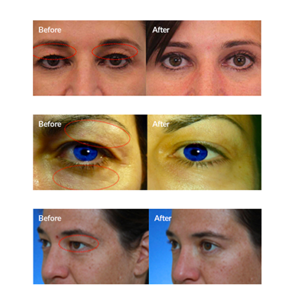 Lasery dermatologiczne plamsa bt plasma bt