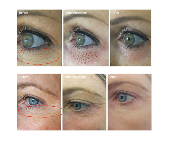 Lasery dermatologiczne plamsa bt plasma bt