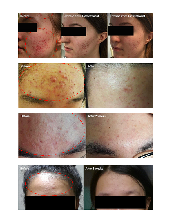 Lasery dermatologiczne plamsa bt plasma bt