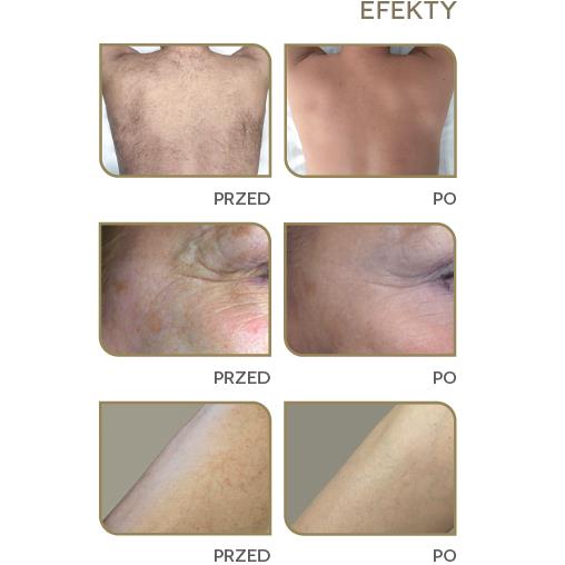 Lasery dermatologiczne Quanta System Thunder