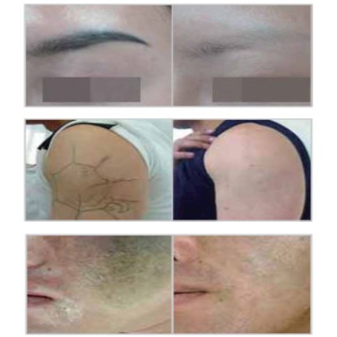 Lasery dermatologiczne Wontech Pastelle