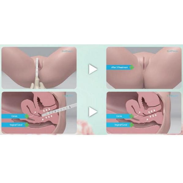 Lasery ginekologiczne LestheZone ThermVital