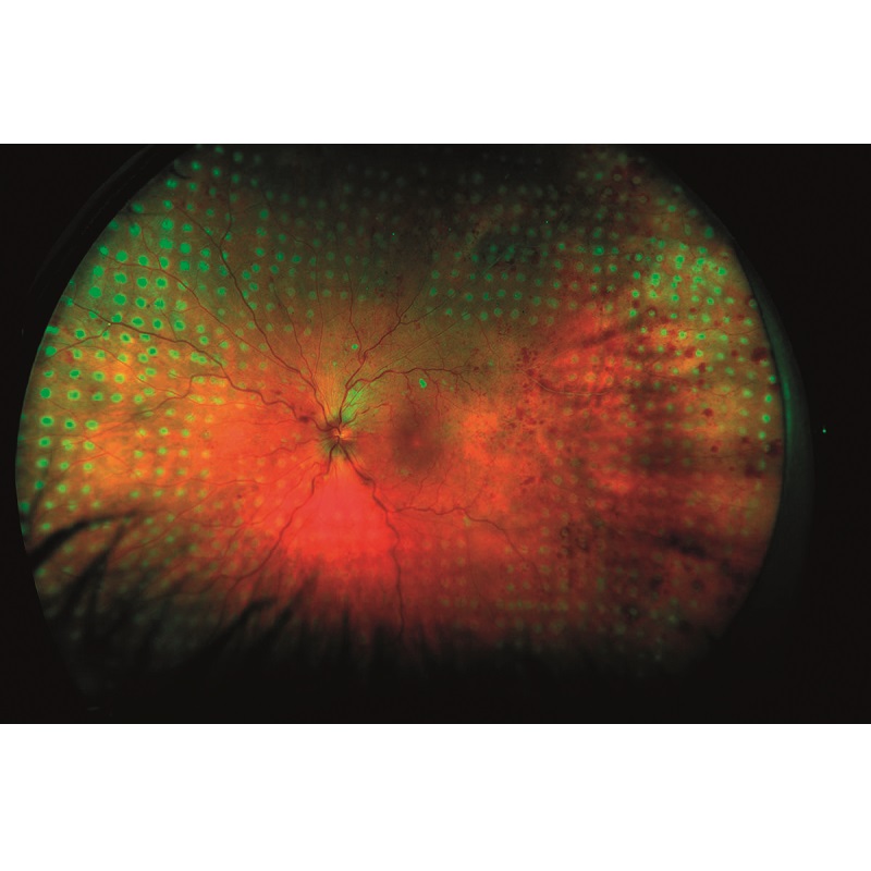 Lasery okulistyczne Ellex Integre Pro Scan