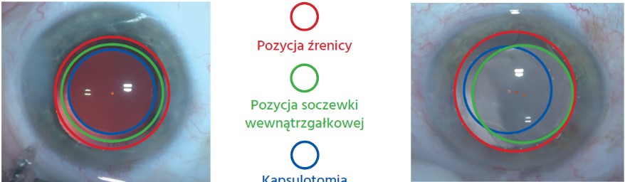 Lasery okulistyczne EXCEL-LENS CAPSULaser