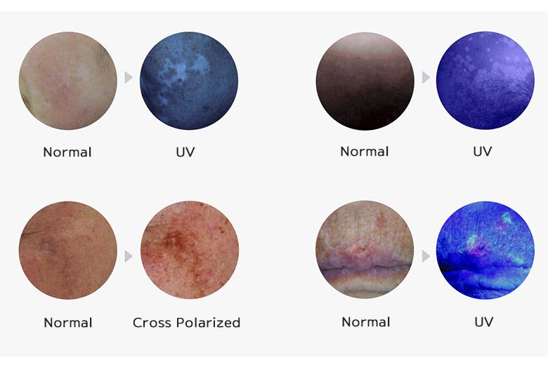 Lupy zabiegowe Illuco IDS-3100