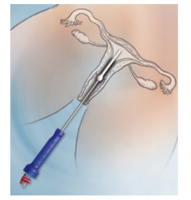 Manipulatory macicy do endoskopów sztywnych Peters Surgical CAUT60