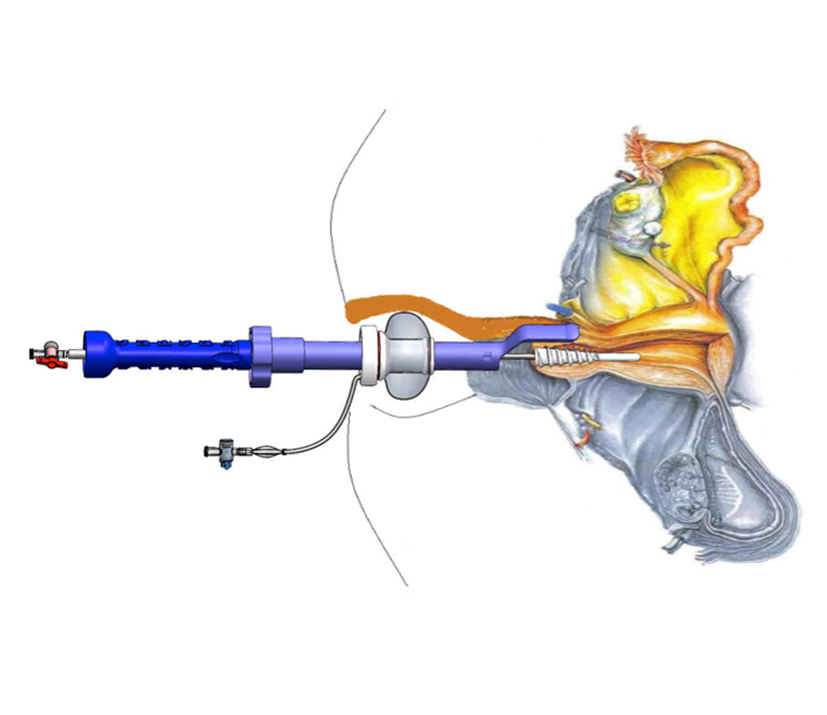 Manipulatory macicy do endoskopów sztywnych Peters Surgical MAUT60