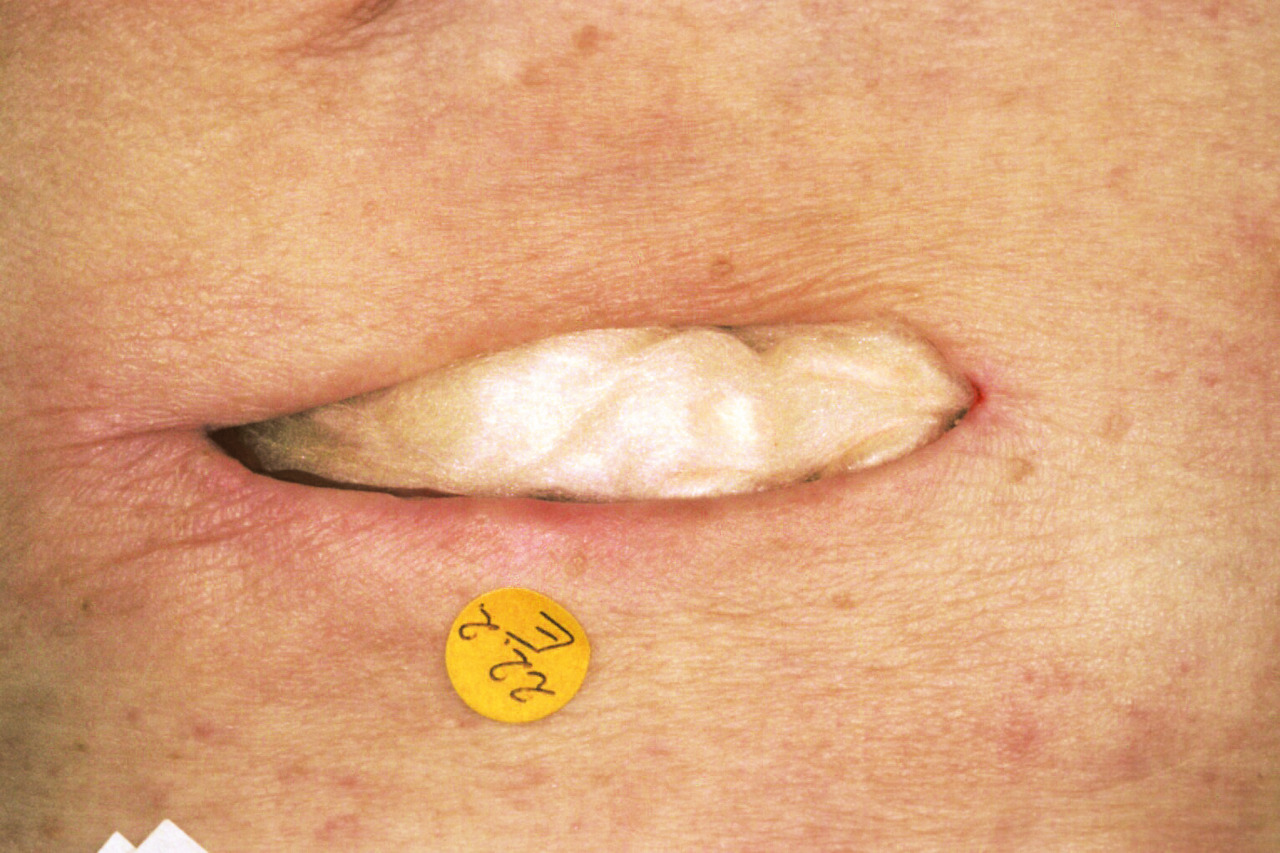 Opatrunki alginianowe HARTMANN Sorbalgon/Sorbalgon T