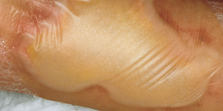 Opatrunki hydrokoloidowe HARTMANN Hydrocoll