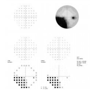 Perymetry komputerowe - polomierze FREY AP-300