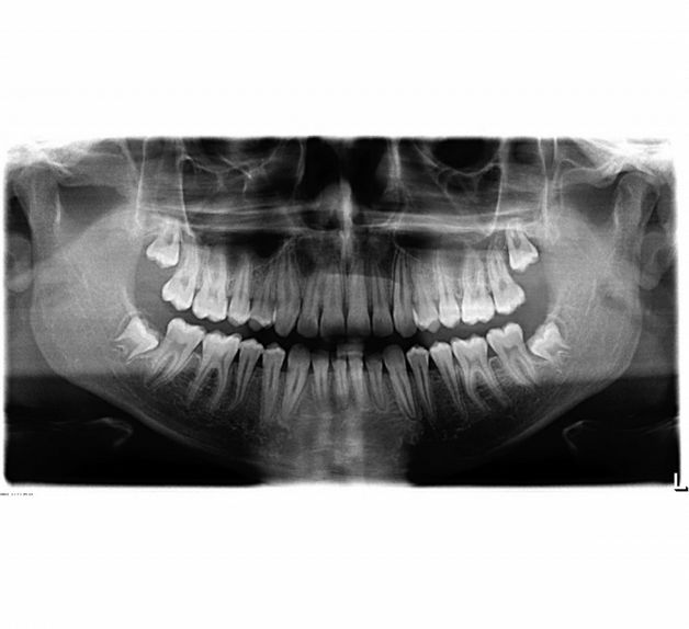 RTG pantomograficzne Sirona Orthophos XG 5