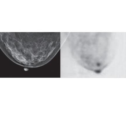 Skanery PET - mammograficzne ONCOVISION Mammi