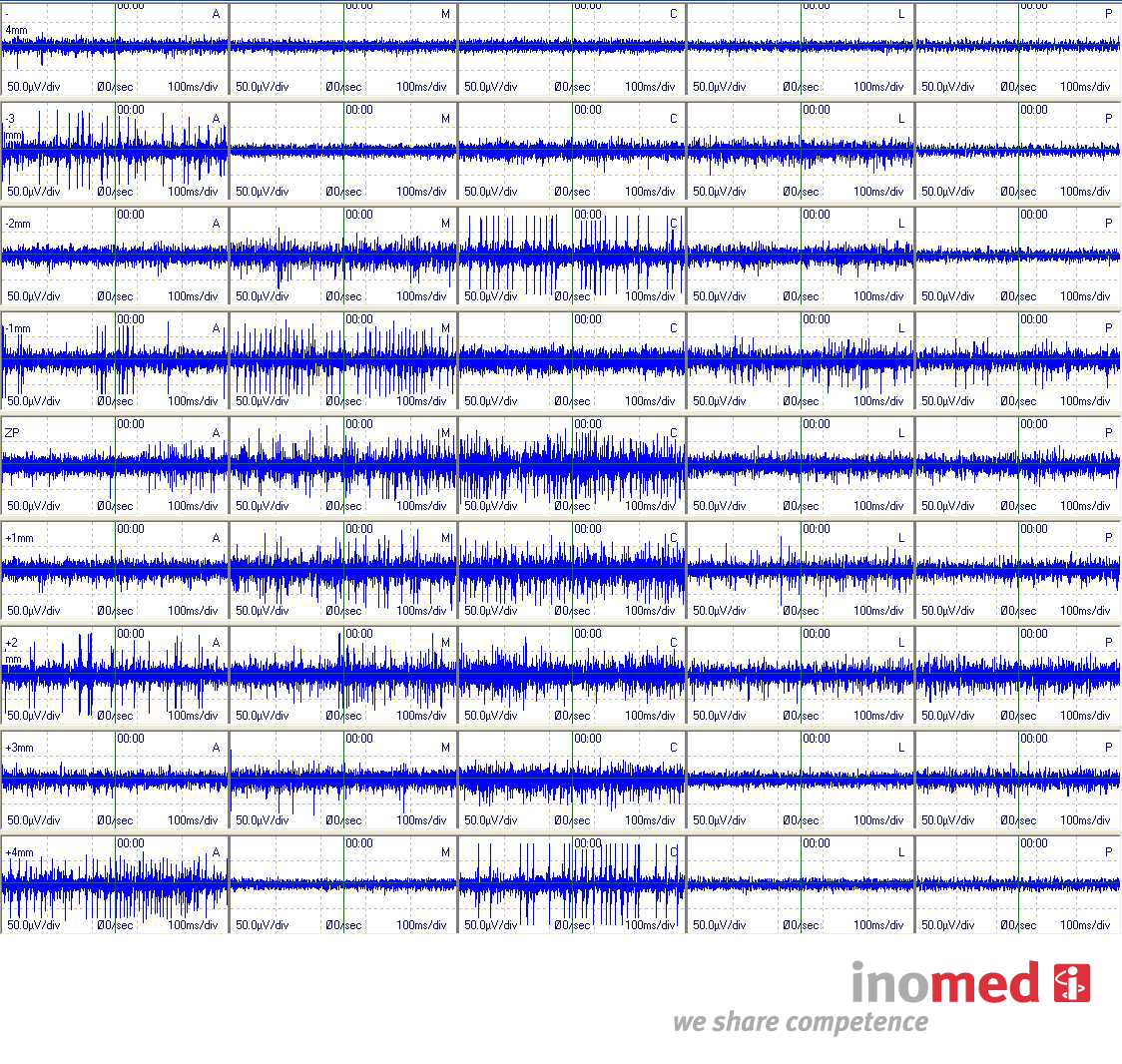 Systemy stereotaktyczne do neurochirurgii inomed Medizintechnik GmbH Microdrive