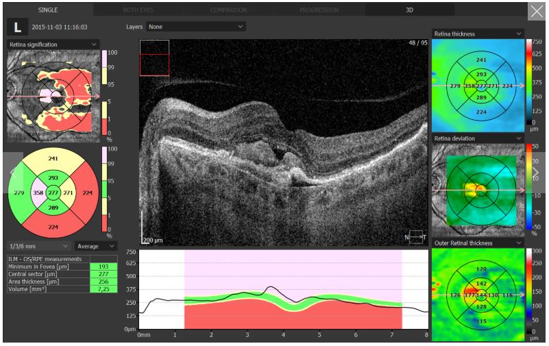 Tomografy okulistyczne (OCT) OPTOPOL REVO 80