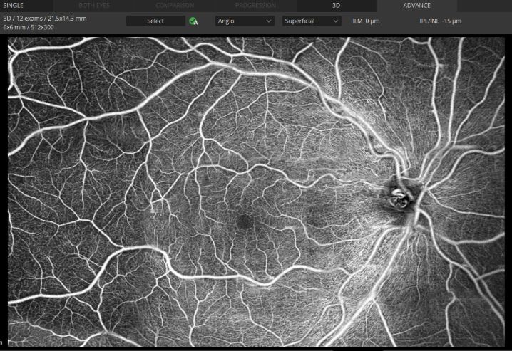 Tomografy okulistyczne (OCT) OPTOPOL REVO NX