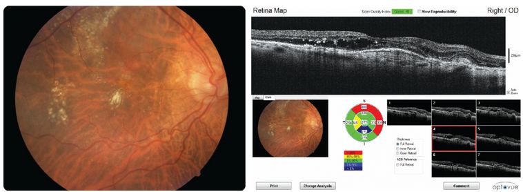 Tomografy okulistyczne (OCT) Optovue iFusion