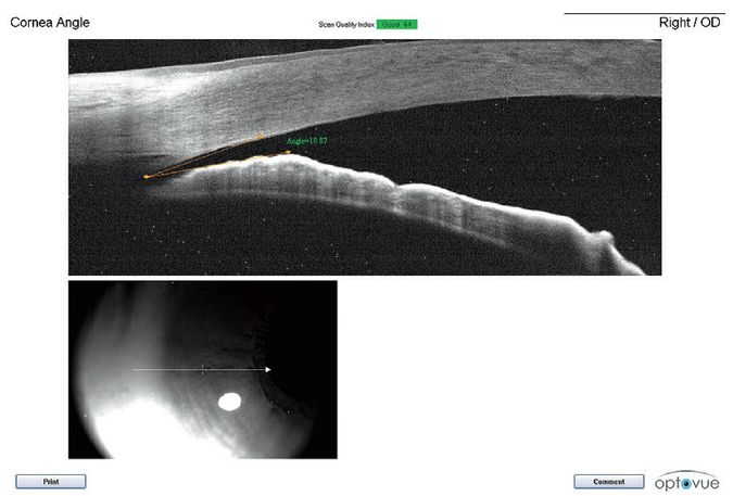 Tomografy okulistyczne (OCT) Optovue iScan80