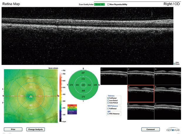 Tomografy okulistyczne (OCT) Optovue iScan80