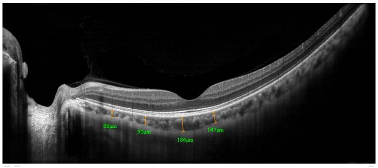 Tomografy okulistyczne (OCT) Optovue RTVue VTRAC Premier