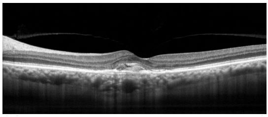 Tomografy okulistyczne (OCT) Optovue RTVue VTRAC Premier