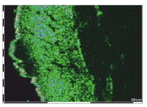 Ultrasonografy dermatologiczne tpm DUB cutis