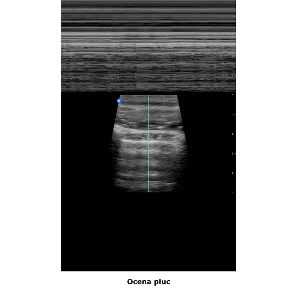 Ultrasonografy kieszonkowe ręczne (USG) Butterfly iQ+