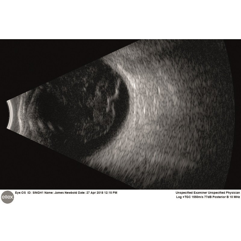 Ultrasonografy okulistyczne Ellex Eye One