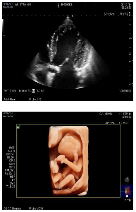 Ultrasonografy stacjonarne wielonarządowe - USG FUJIFILM ARIETTA V70