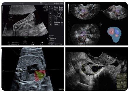 Ultrasonografy stacjonarne wielonarządowe - USG GE Healthcare VOLUSON Performance 18