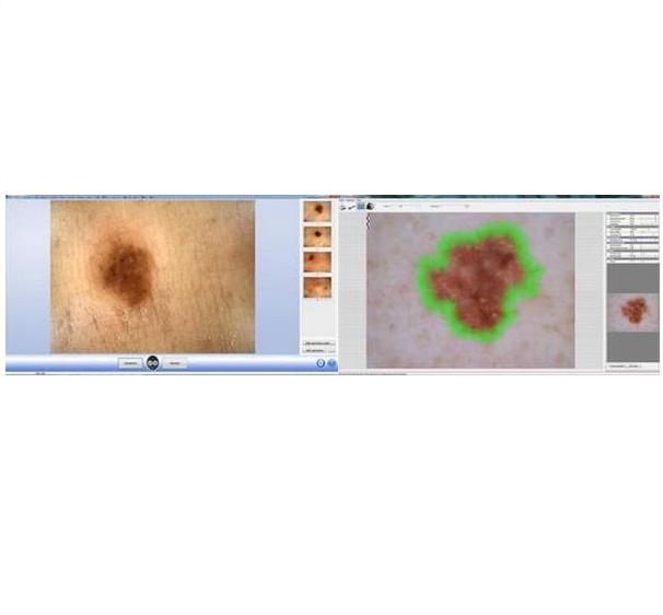 Videodermatoskopy DermoScan DermoGenius Live