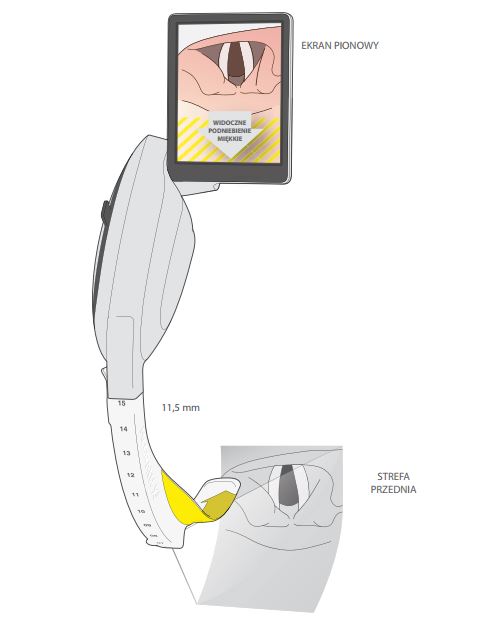 Wideolaryngoskopy do intubacji Aircraft Medical Ltd. McGrath MAC