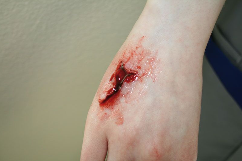 Zestawy do pozoracji ran 3B Scientific WS01