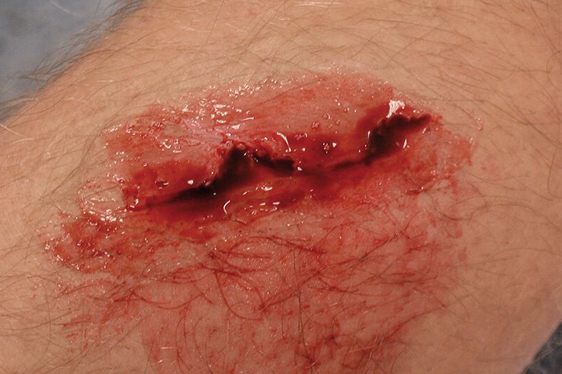 Zestawy do pozoracji ran 3B Scientific WS02