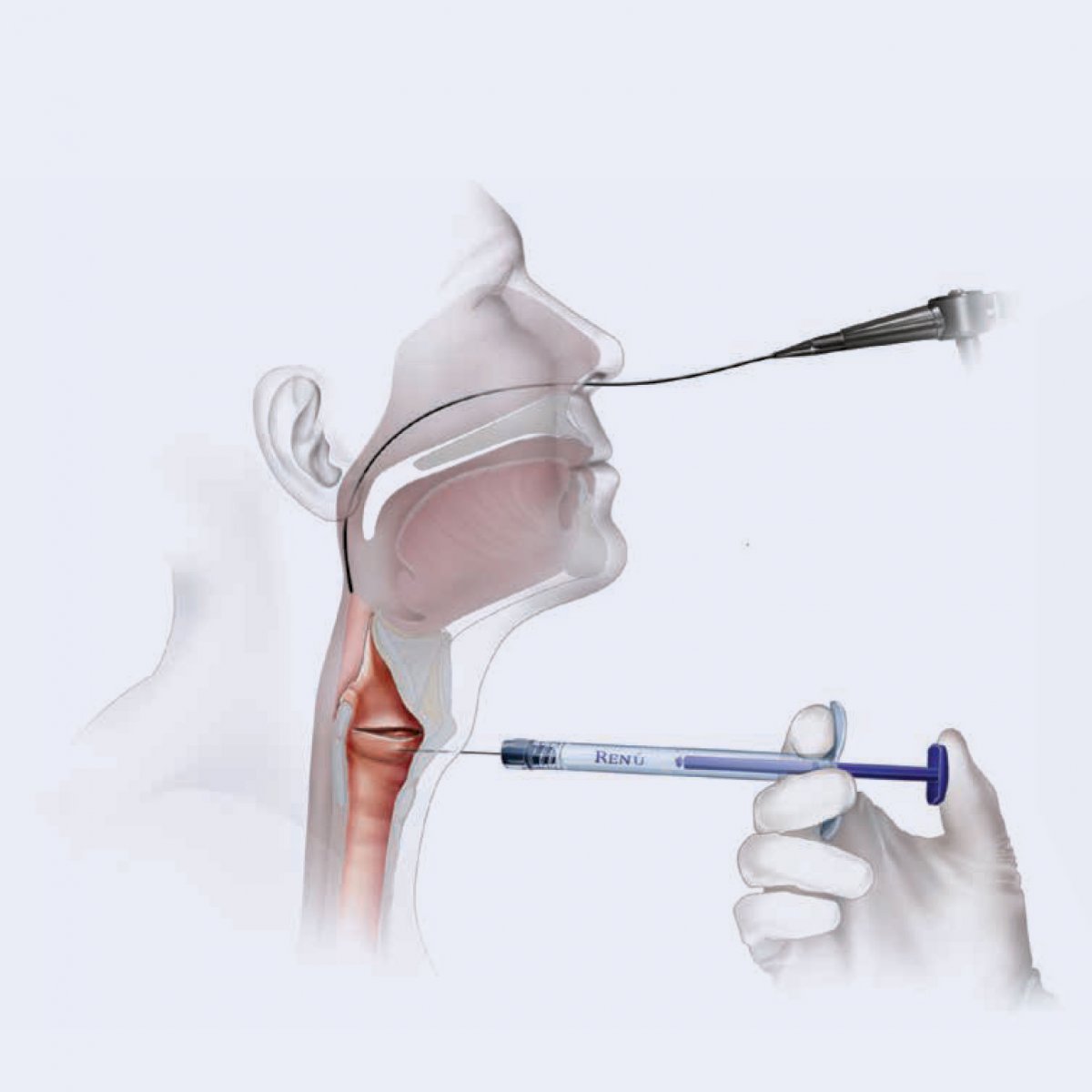 Implanty iniekcyjne laryngologiczne