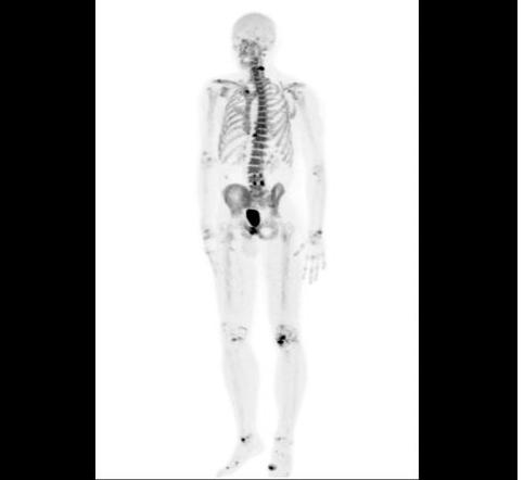 Fluorek sodu pomoże wykryć nowotwór w kościach